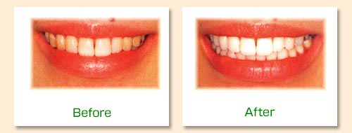 矯正歯科 審美歯科 インプラント 噛み合わせ治療 蕨　歯科 ほそい歯科クリニック